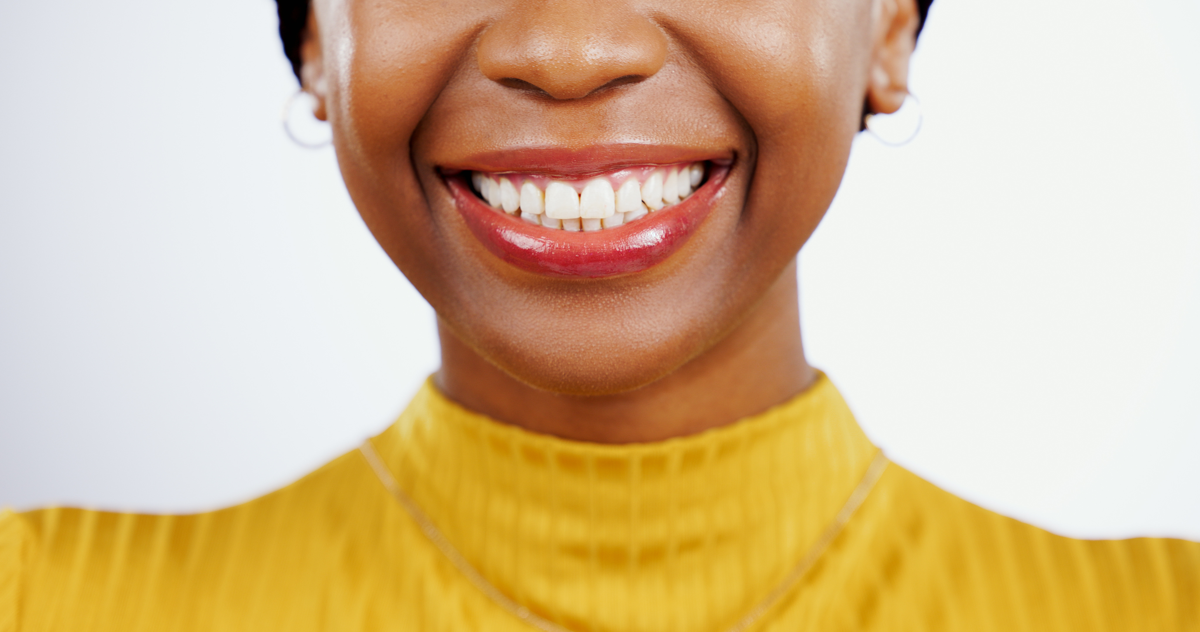 Dental veneers — cosmetic smile transformation